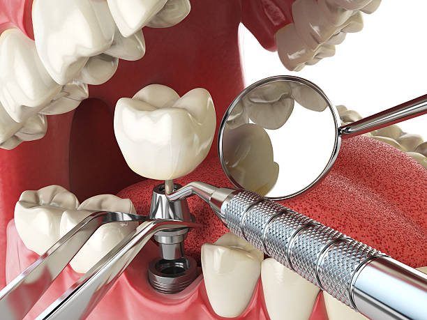 Best Emergency Tooth Extraction in Sebring, OH